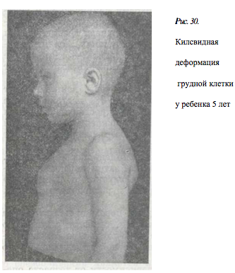 килевидная деформация грудной клетки у ребенка 5 лет