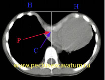 Симметричная воронкоообразная деформация грудной клетки