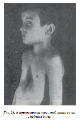 асимметричная воронкообразная грудь у ребенка 6 лет