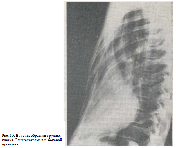 Рентгенограмма в боковой проекции воронкообразной груди