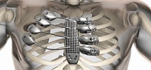 Имплант грудины, изготовленный на 3D-принтере